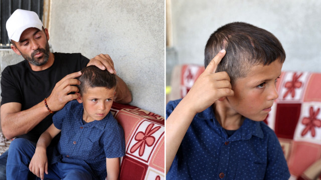 Köpek ısırması nedeniyle 6 ameliyat geçirmişti: Yedi yaşındaki Emir’in başında saldırının izleri kaldı